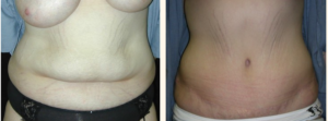 Tummy Tuck Before & After Photo