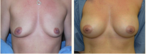 Breast Augmentation Before & After Photo