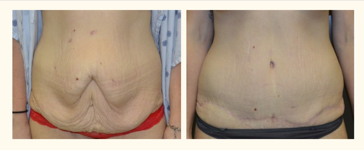 Tummy Tuck (Abdominoplasty) Mississauga Toronto ON