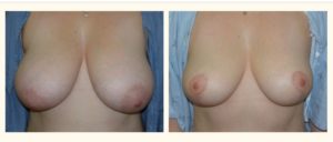Breast Lift Before and After Images