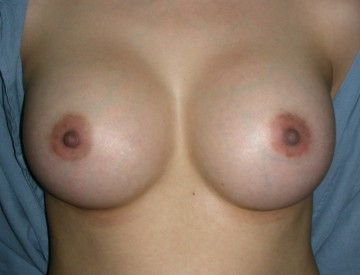 Breast Augmentation - After