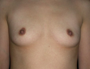 Breast Augmentation - Before